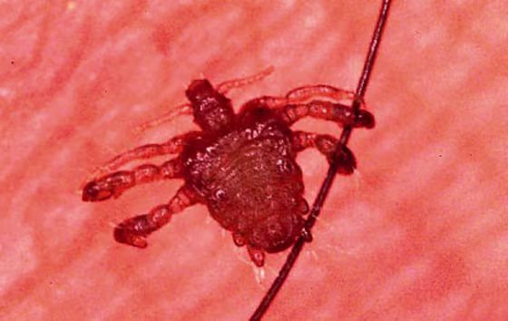 Image: Crab louse